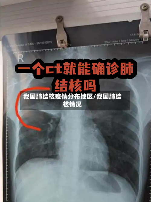 我国肺结核疫情分布地区/我国肺结核情况